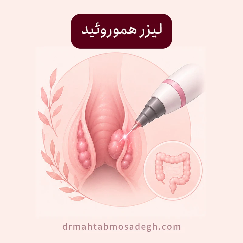 برداشت هموروئید با لیزر